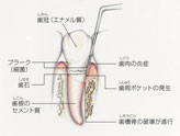 軽度歯周病（通院3回程度）料金表