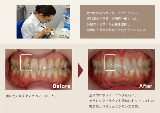 歯科技工士によるプロの仕上がり