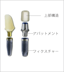 インプラントの基本構造