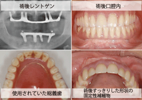 All-on-4で治療したインプラント症例